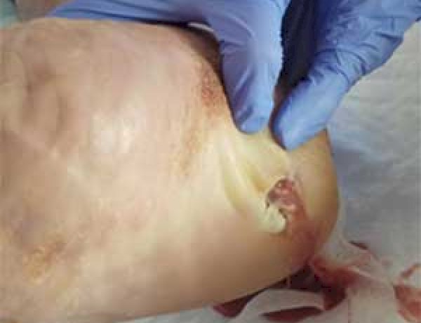 Remédio do Iepa (Amapá) cura o pé diabético e no RJ é a principal causa de amputação